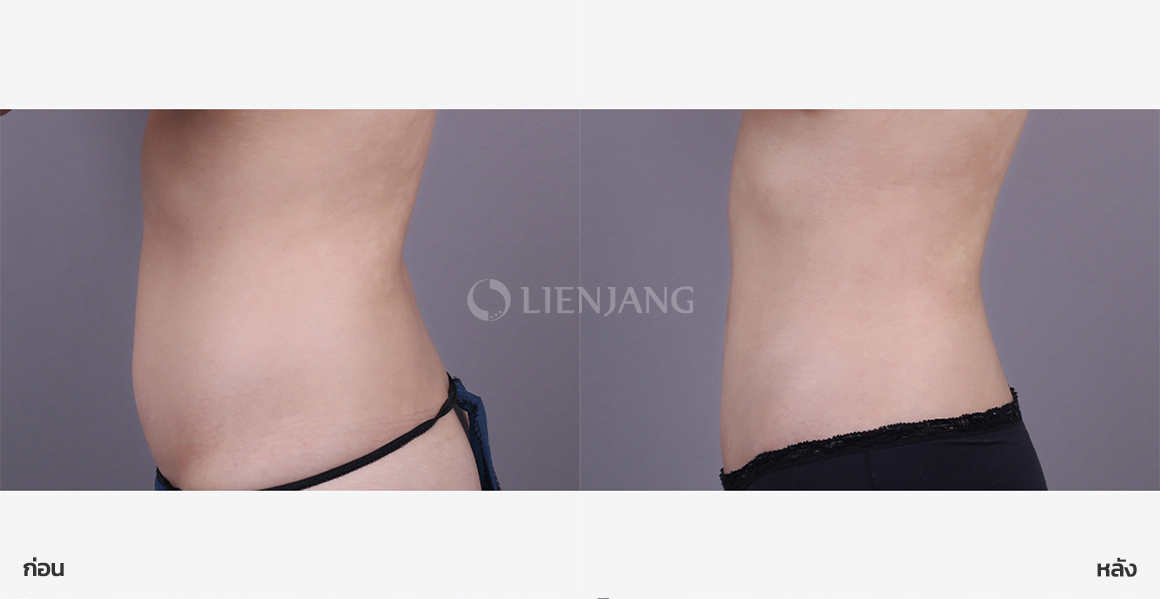 Full abdominal liposuction · 2 months after surgery — Lienjang case #171