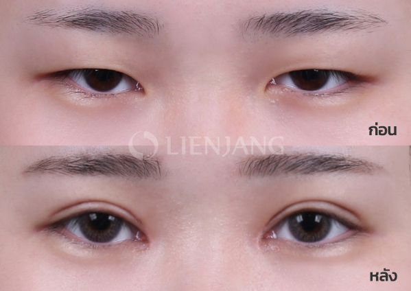 Epicanthoplasty + Incisional double eyelid · 1 month after surgery — Lienjang case #011