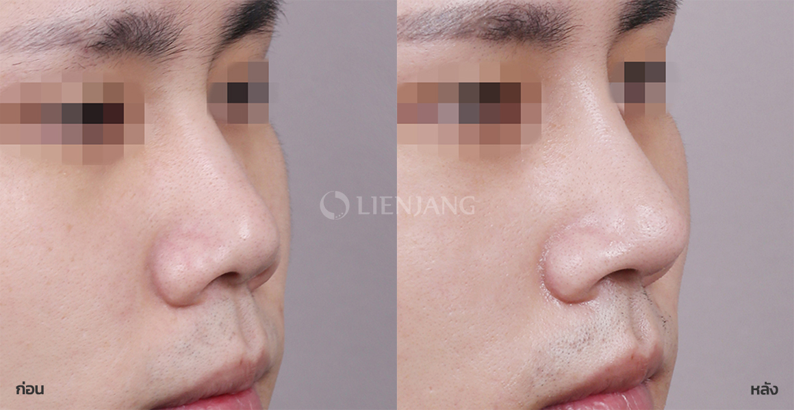 Rhinoplasty: bridge + tip · 1 month after surgery — Lienjang case #074