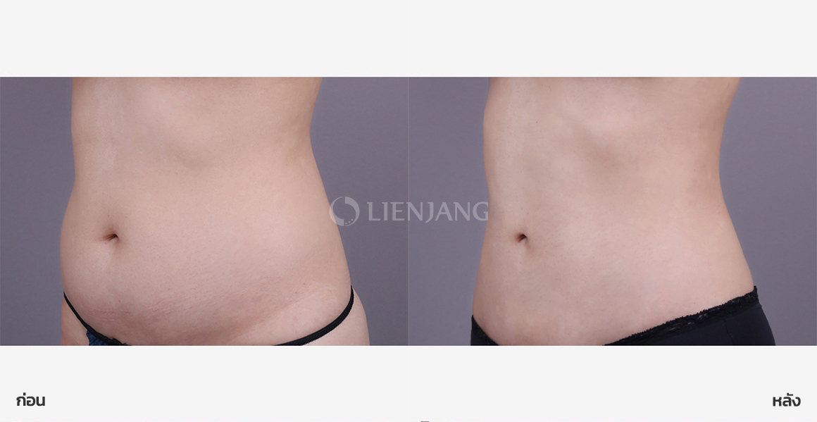 Full abdominal liposuction · 2 months after surgery — Lienjang case #172