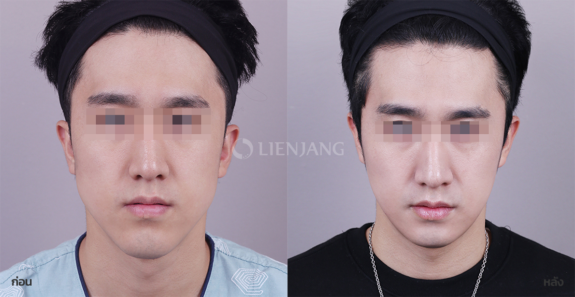 Square-jaw reduction · 6 months after surgery — Lienjang case #113