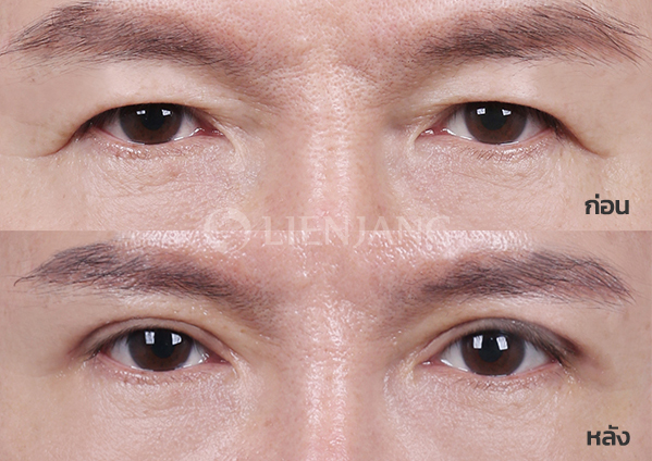 Upper blepharoplasty · 1 week after surgery — Lienjang case #012