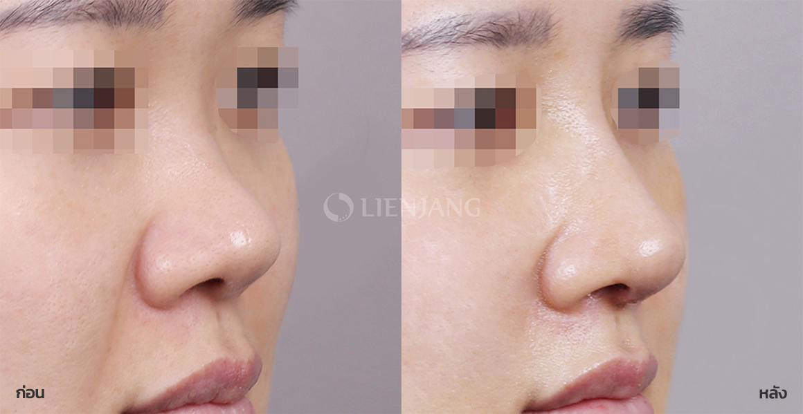 Rhinoplasty: bridge + tip · 1 week after surgery — Lienjang case #075