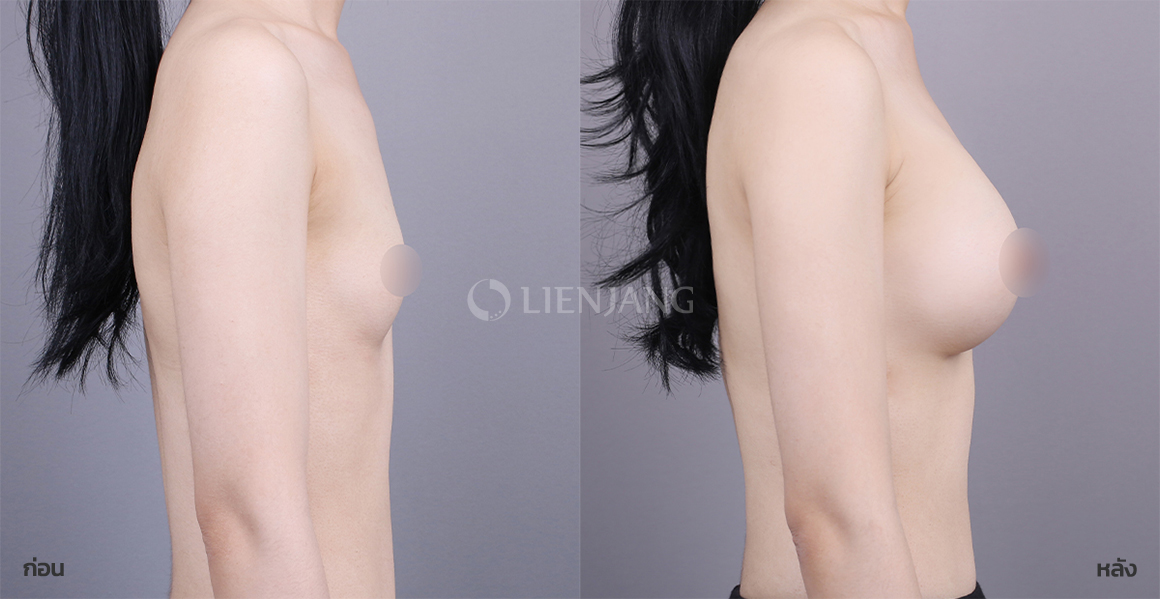 Breast augmentation · 6 months after surgery — Lienjang case #140
