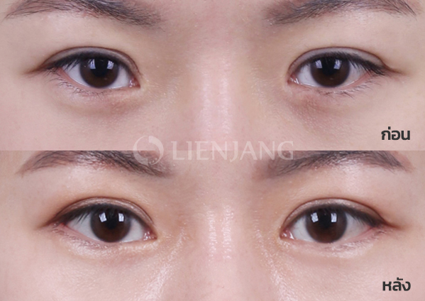 Dual epicanthoplasty · 3 months after surgery — Lienjang case #013