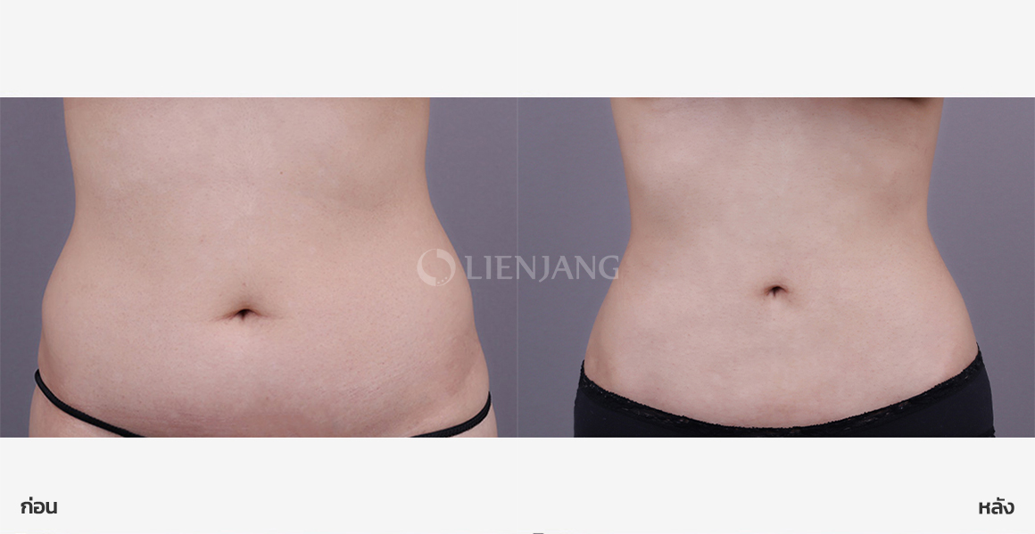 Full abdominal liposuction · 2 months after surgery — Lienjang case #173