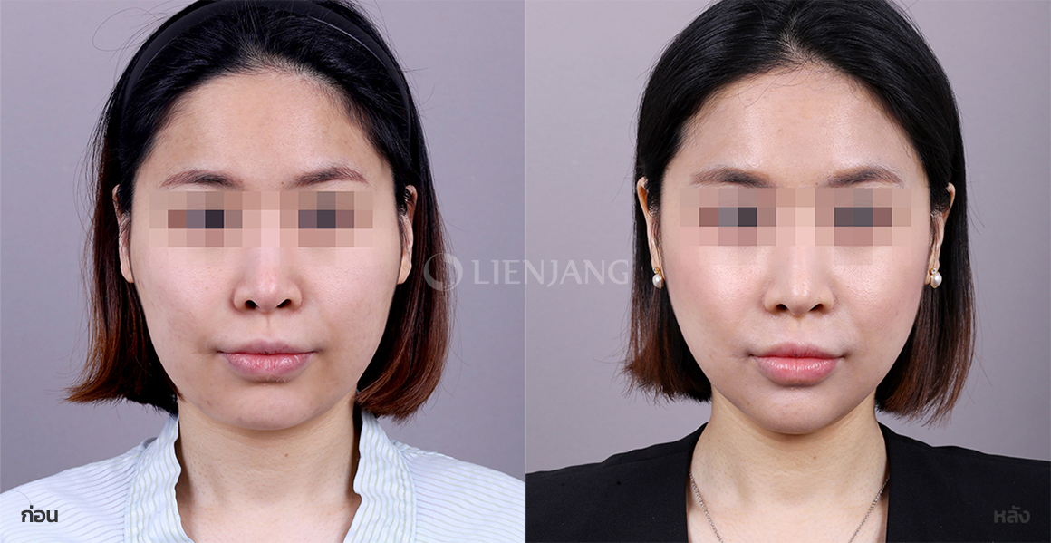 Square-jaw reduction + Genioplasty · 2 months after surgery — Lienjang case #114