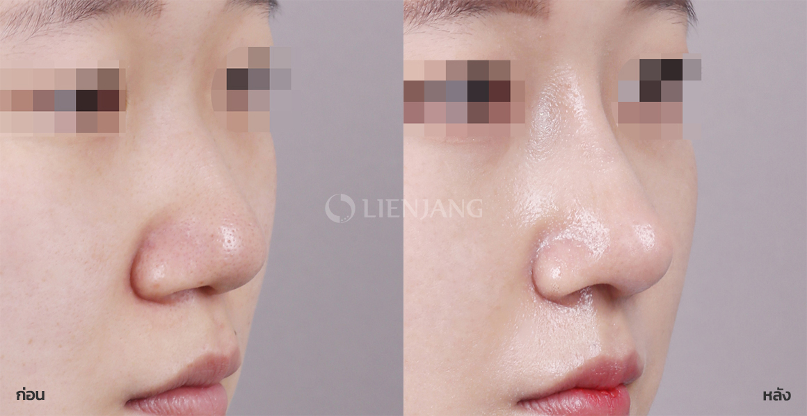 Rhinoplasty: bridge + tip · 1 month after surgery — Lienjang case #076