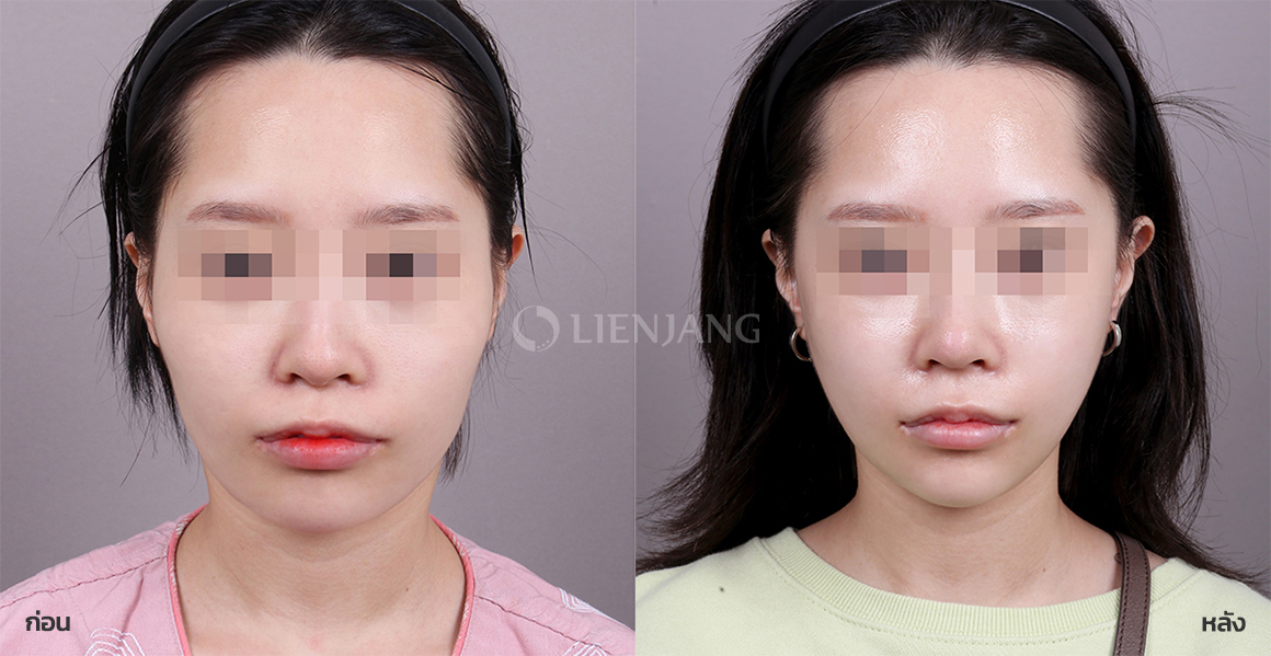 ลดโหนกแก้ม + ศัลยกรรมกราม + ศัลยกรรมคาง · หลังผ่าตัด 3 เดือน — Lienjang case #100