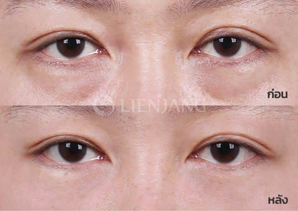 Under-eye fat repositioning · 1 month after surgery — Lienjang case #014