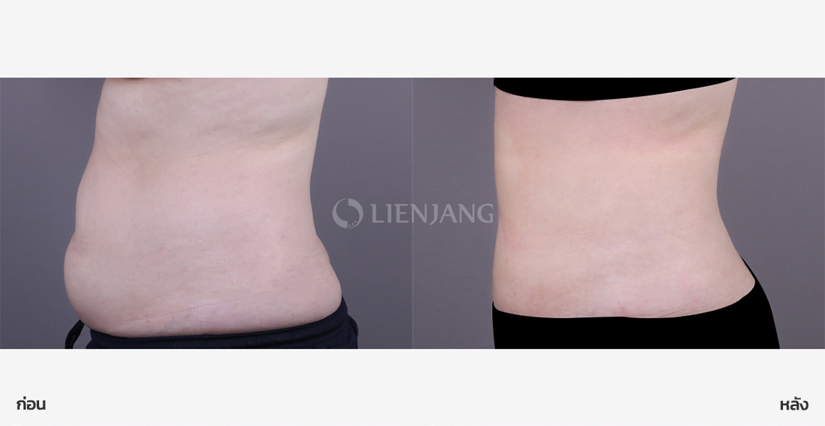 Full abdominal liposuction · 1 month after surgery — Lienjang case #174