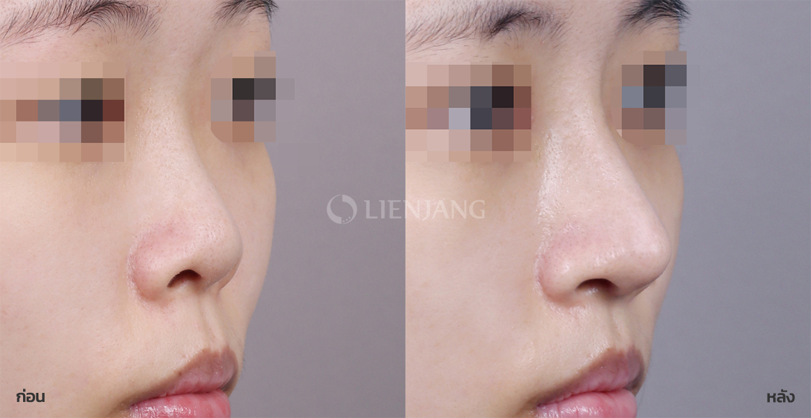 Rhinoplasty: bridge + tip · 1 month after surgery — Lienjang case #077