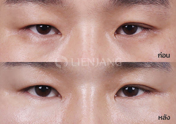 Under-eye fat repositioning · 2 weeks after surgery — Lienjang case #015