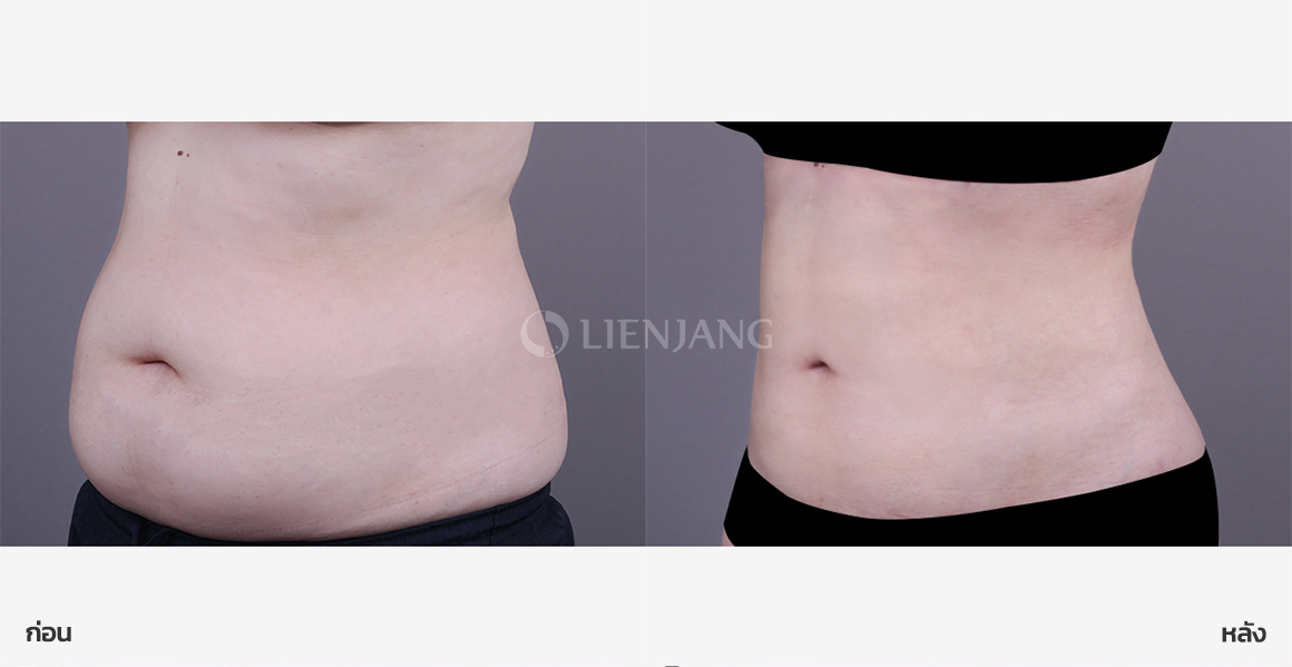 Full abdominal liposuction · 1 month after surgery — Lienjang case #175