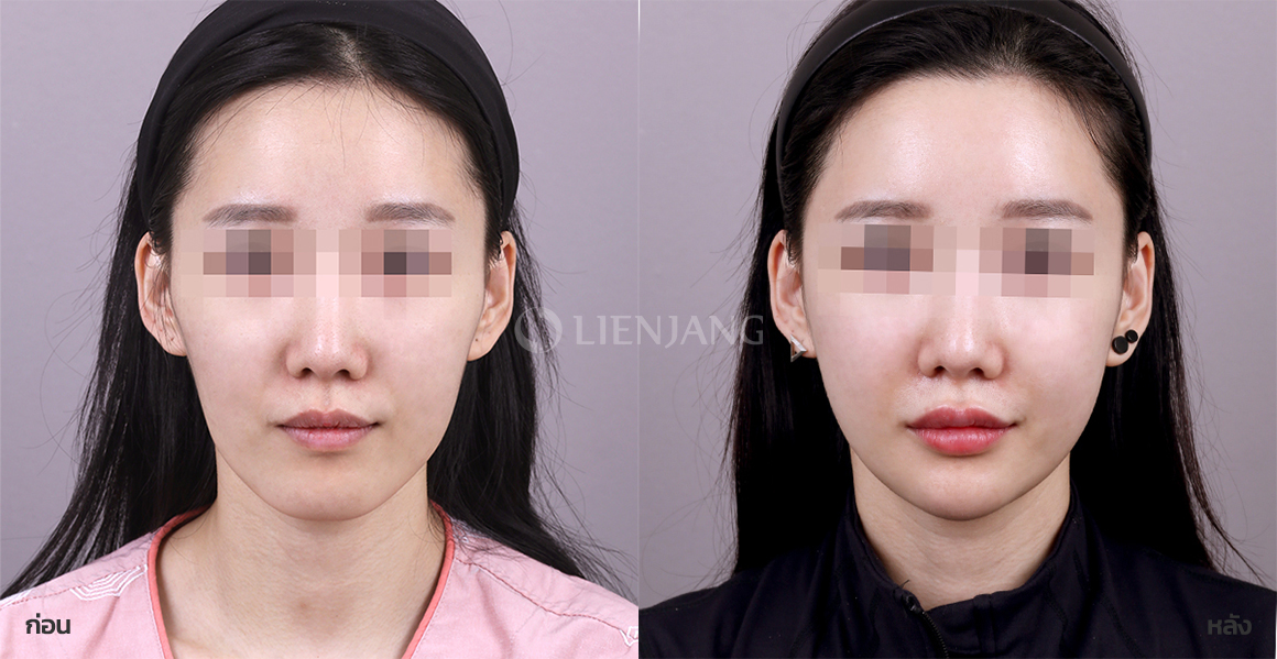 ศัลยกรรมกราม + ศัลยกรรมคาง · หลังผ่าตัด 3 เดือน — Lienjang case #101