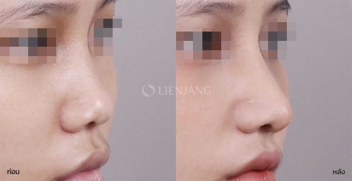 Rhinoplasty: bridge + tip · 1 month after surgery — Lienjang case #078