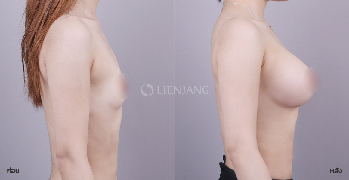 Breast augmentation · 5 months after surgery — Lienjang case #143