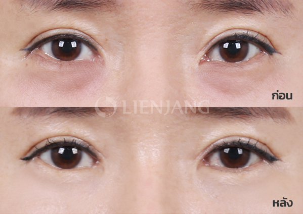 Under-eye fat repositioning · 1 month after surgery — Lienjang case #016