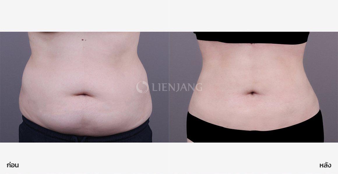 Full abdominal liposuction · 1 month after surgery — Lienjang case #157