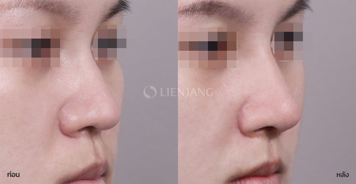Rhinoplasty: bridge + tip · 2 months after surgery — Lienjang case #079