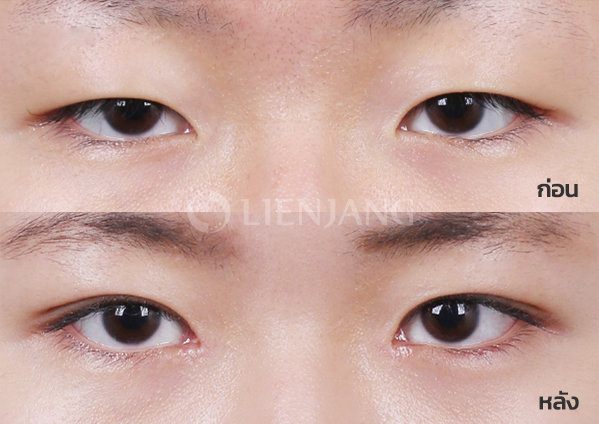 Ptosis correction · 1 month after surgery — Lienjang case #017