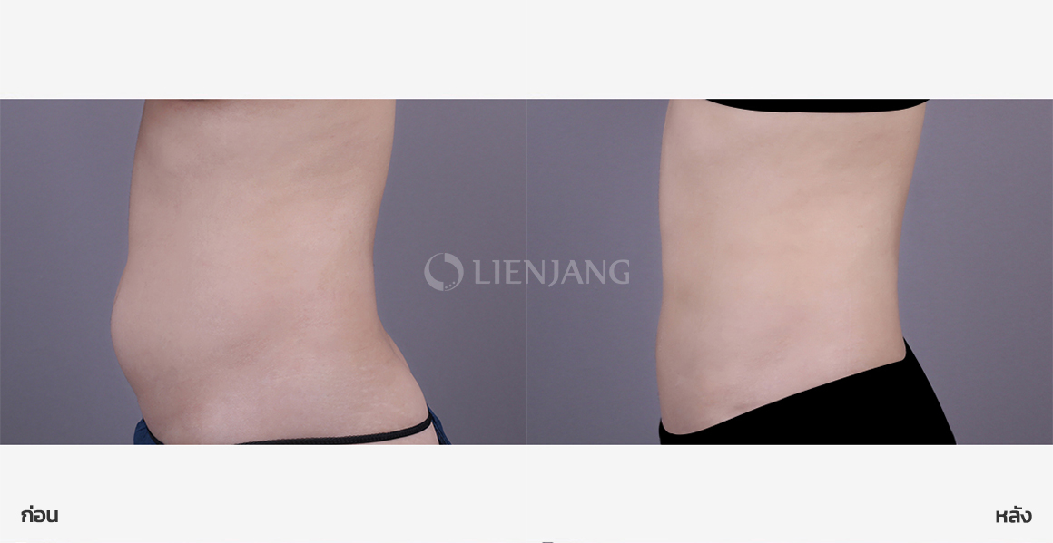 Full abdominal liposuction · 3 weeks after surgery — Lienjang case #158