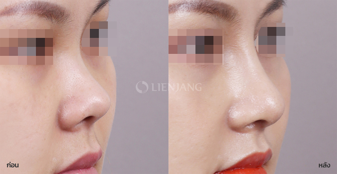 Rhinoplasty: bridge + tip · 1 month after surgery — Lienjang case #080