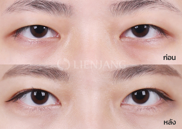 Ptosis correction · 1 month after surgery — Lienjang case #018