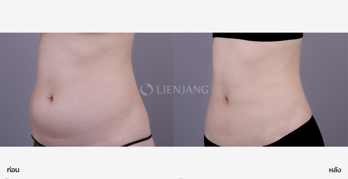 Full abdominal liposuction · 3 weeks after surgery — Lienjang case #159