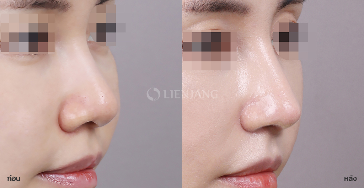 Rhinoplasty: bridge + tip · 1 month after surgery — Lienjang case #081