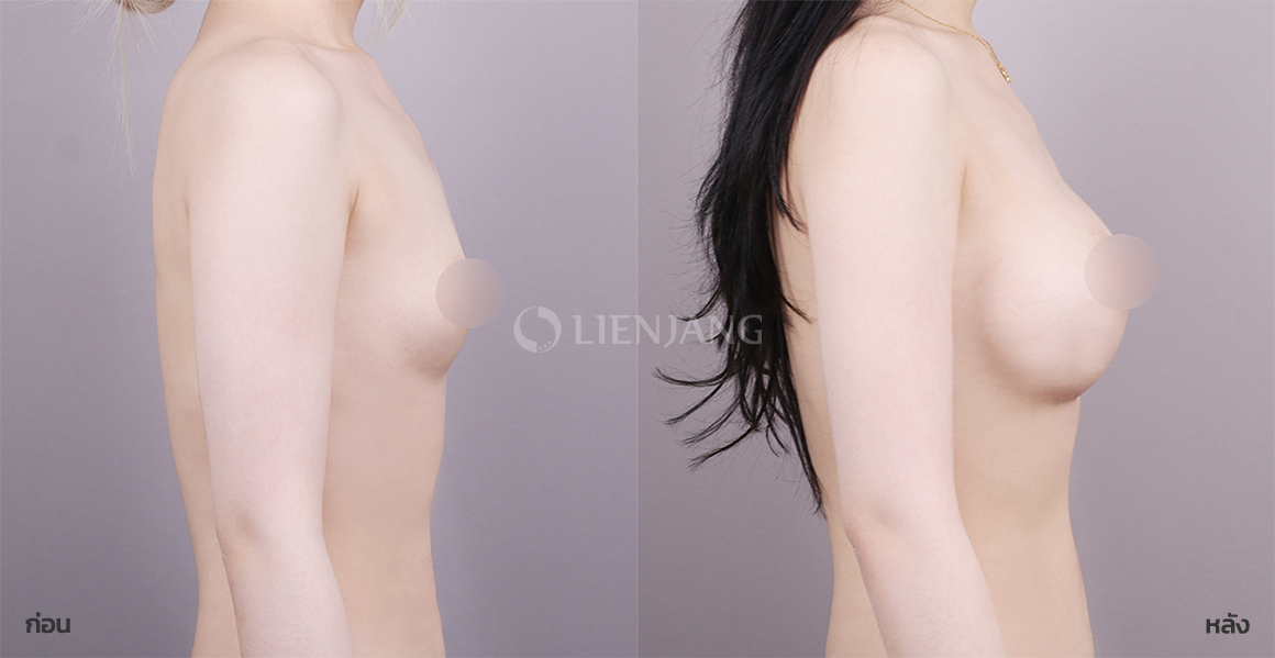 Breast augmentation (smooth implant) · 6 months after surgery — Lienjang case #146