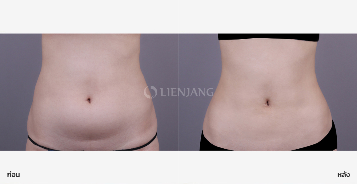 Full abdominal liposuction · 3 weeks after surgery — Lienjang case #160