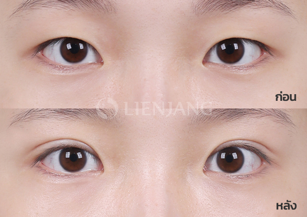 Natural-adhesion double eyelid + Double eyelid surgery · 1 month after surgery — Lienjang case #019