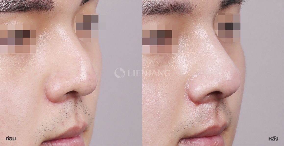 Rhinoplasty: bridge + tip · 1 month after surgery — Lienjang case #082
