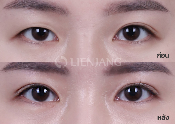 Incisional double eyelid + ptosis correction · 3 months after surgery — Lienjang case #020