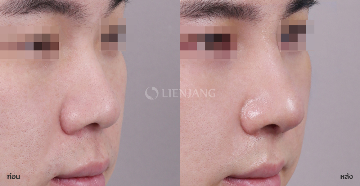 Rhinoplasty: bridge + tip · 3 months after surgery — Lienjang case #083