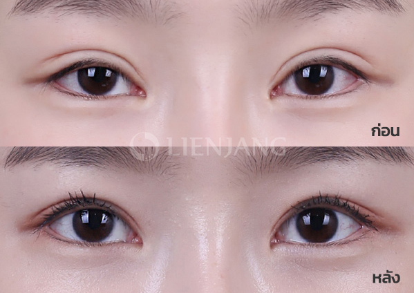Incisional double eyelid + ptosis correction · 5 months after surgery — Lienjang case #021