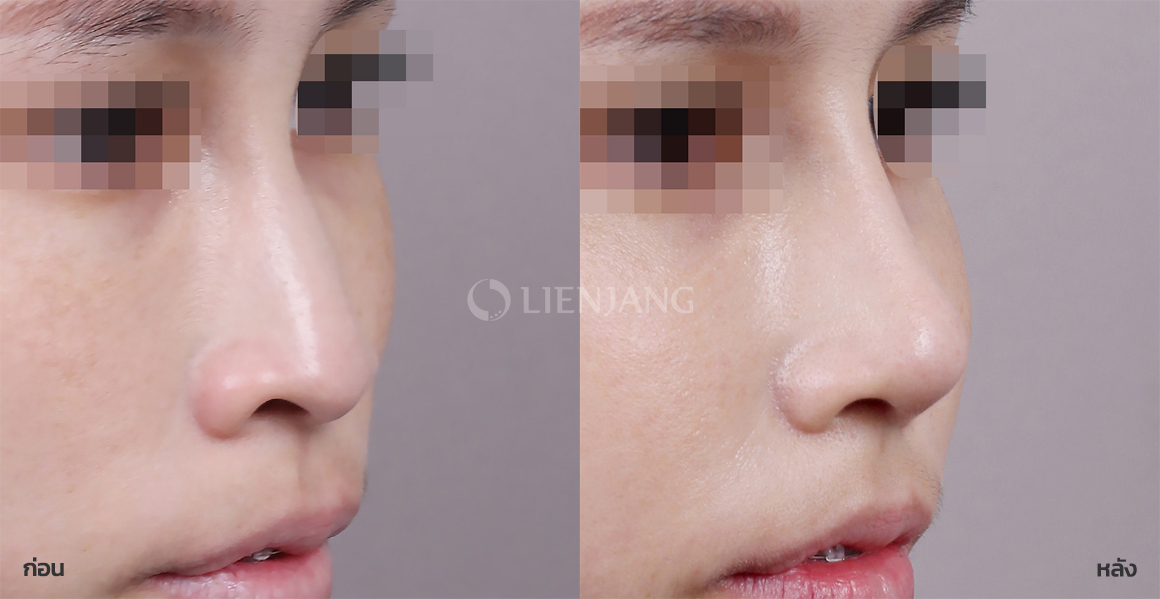 Rhinoplasty: bridge + tip · 2 months after surgery — Lienjang case #084