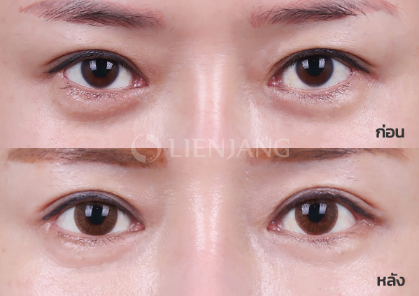 Incisional double eyelid + ptosis correction + Dual epicanthoplasty · 3 months after surgery — Lienjang case #022