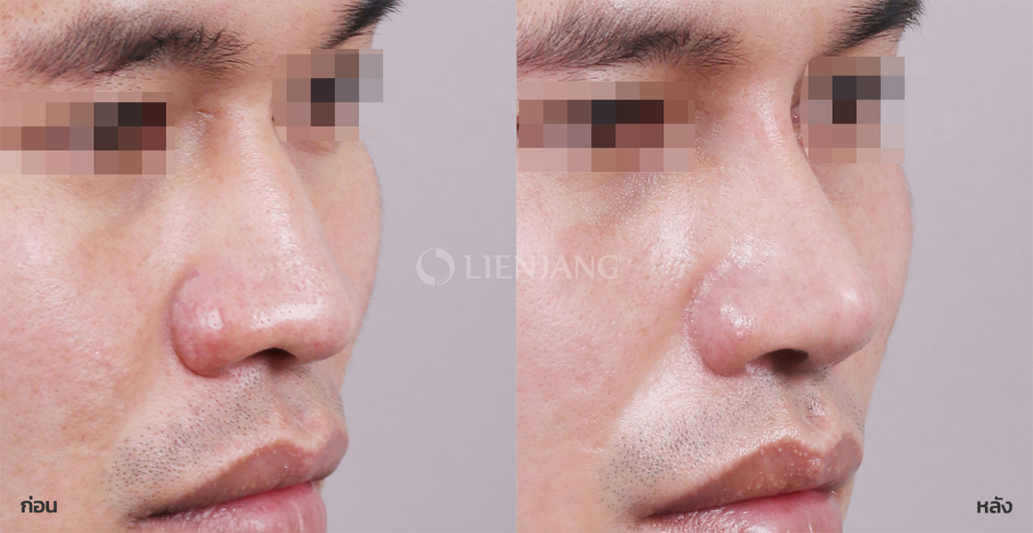 Rhinoplasty: bridge + tip · 3 months after surgery — Lienjang case #085