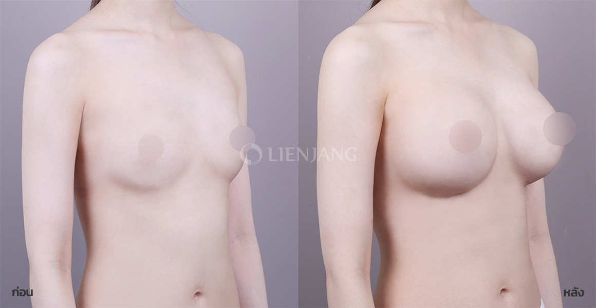 Breast augmentation (smooth implant) · 2 months after surgery — Lienjang case #150