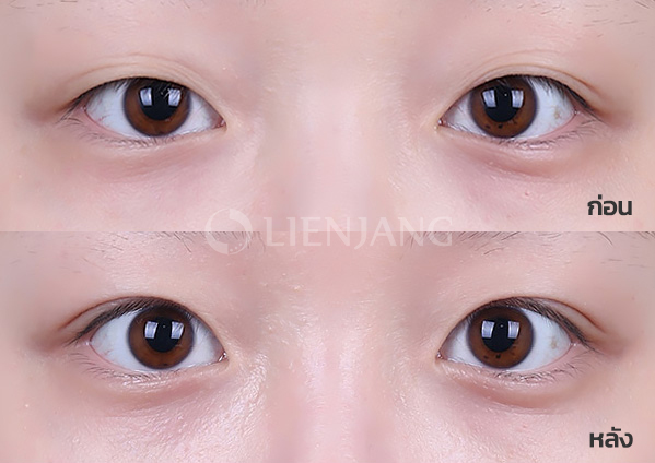 Natural-adhesion double eyelid + Ptosis correction · 3 months after surgery — Lienjang case #023