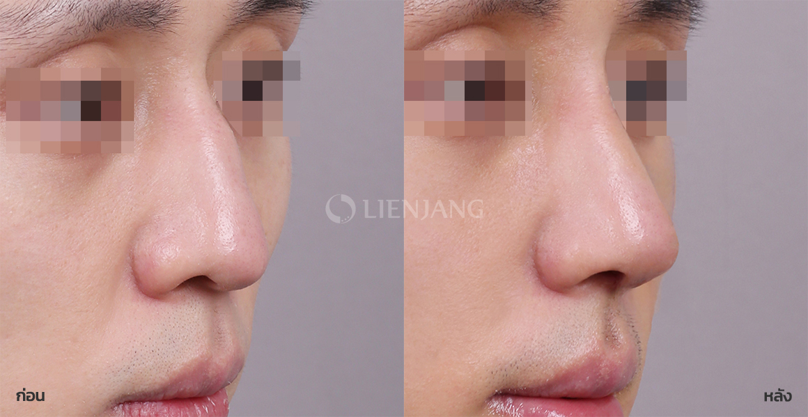 Rhinoplasty: bridge + tip · 3 months after surgery — Lienjang case #086