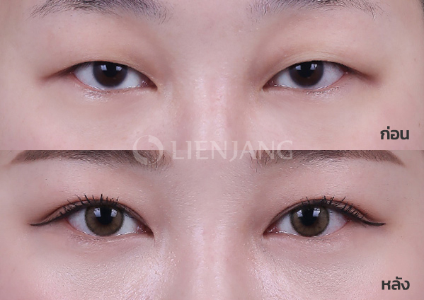 Buried-suture double eyelid + ptosis correction · 3 months after surgery — Lienjang case #024