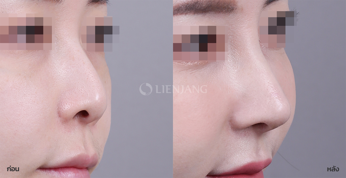 Rhinoplasty: bridge + tip · 12 months after surgery — Lienjang case #087