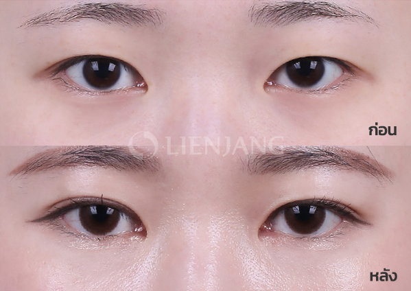 Natural-adhesion double eyelid · 3 months after surgery — Lienjang case #025