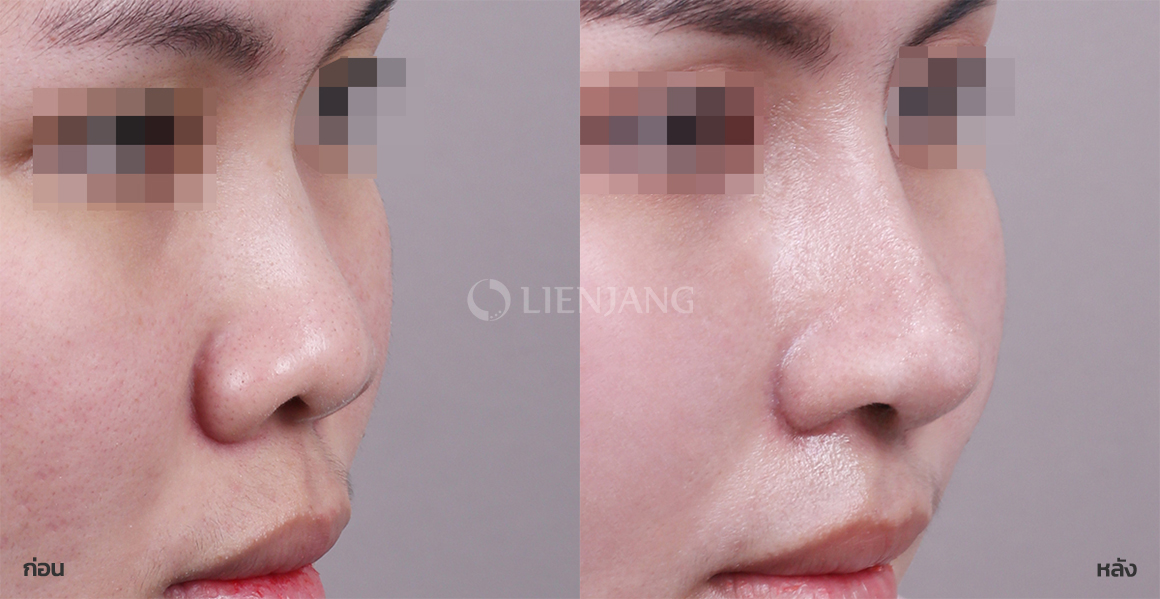 Rhinoplasty: bridge + tip · 3 months after surgery — Lienjang case #088