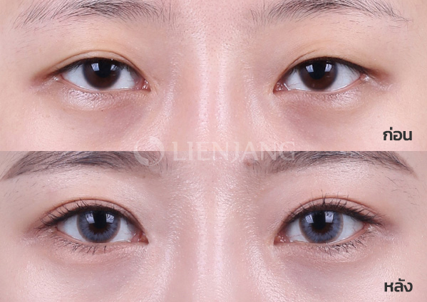 Natural-adhesion double eyelid + Eye revision surgery · 5 months after surgery — Lienjang case #026