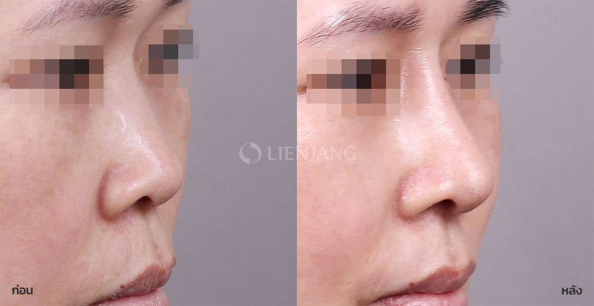 Rhinoplasty: bridge + tip · 6 months after surgery — Lienjang case #089