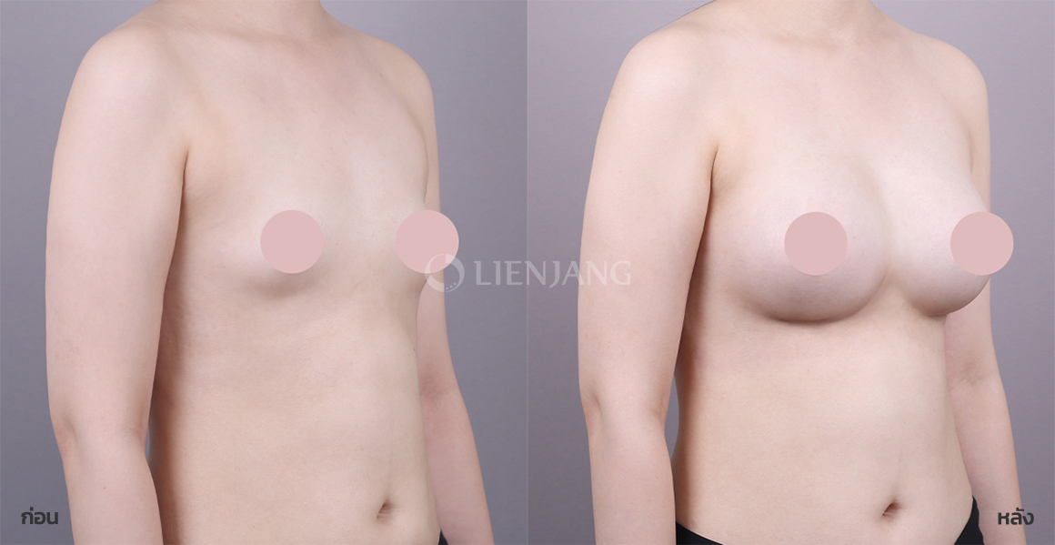 Breast augmentation (microtexture implant) · 2 months after surgery — Lienjang case #153